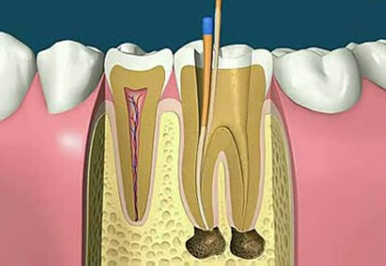 根管治疗