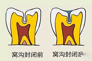 什么时候做窝沟封闭的效果好？